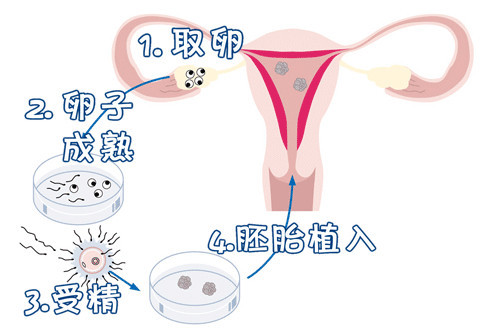 代生供卵公司